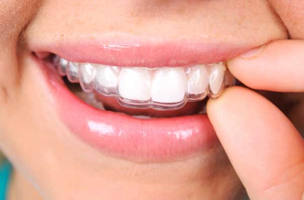 Smiling woman using a clear aligner
